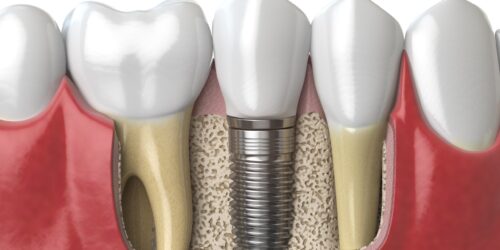 Tooth Replacement with Single Tooth Implants or Bridges in Jacksonville, Florida