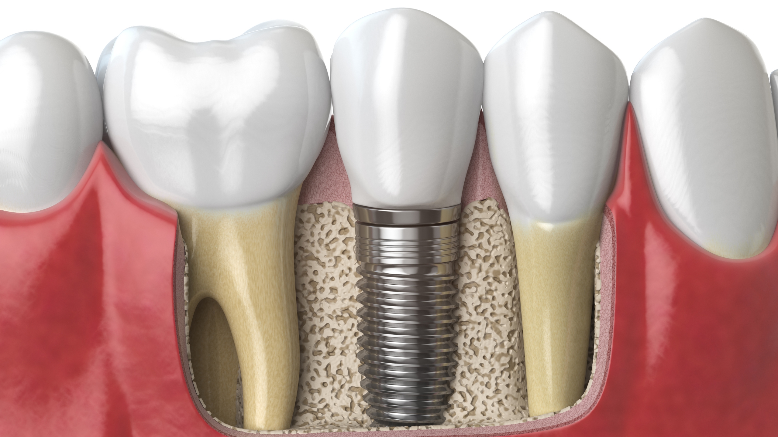 You are currently viewing Tooth Replacement with Single Tooth Implants or Bridges in Jacksonville, Florida