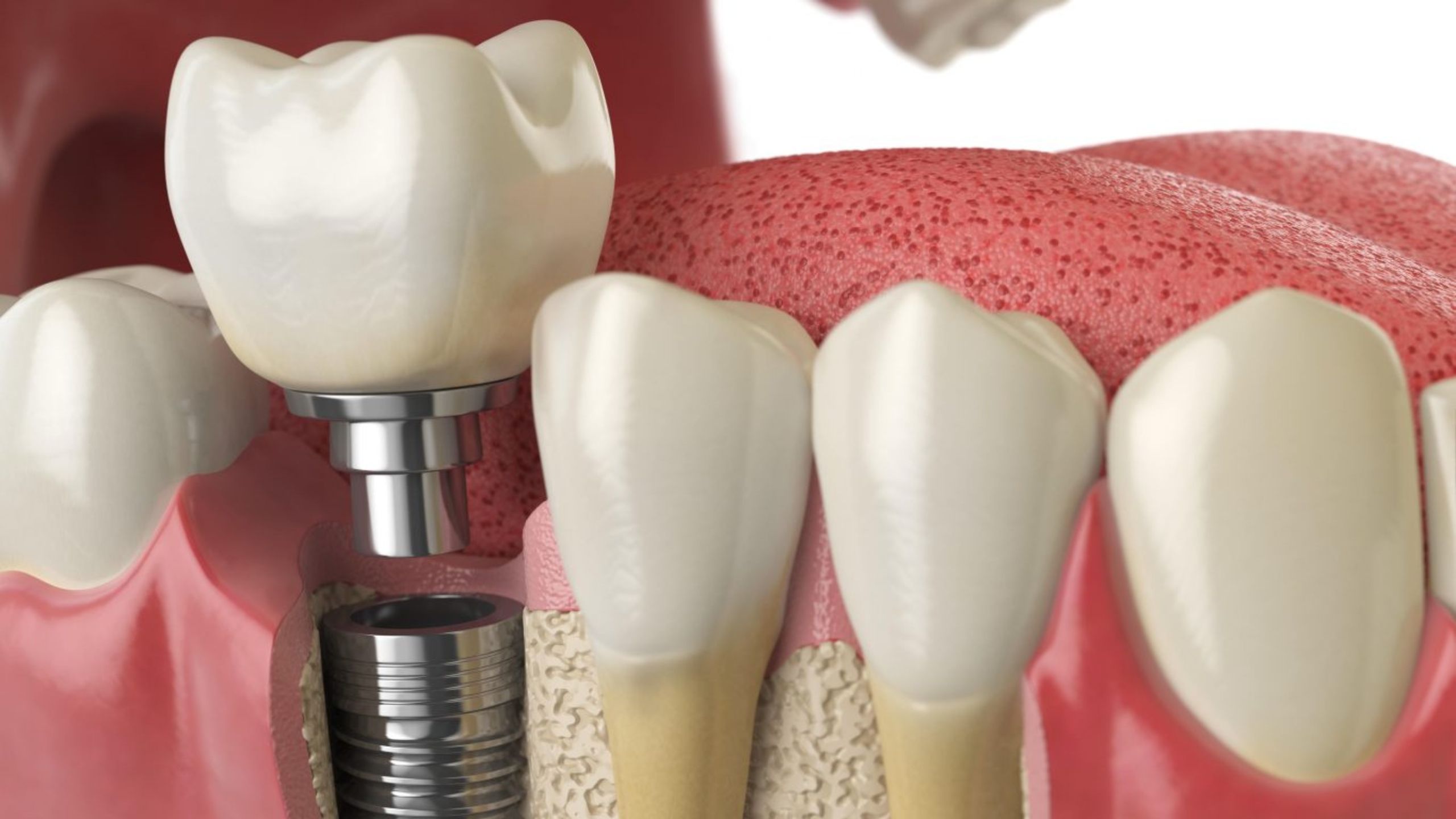 You are currently viewing Why Dental Implants Hurt