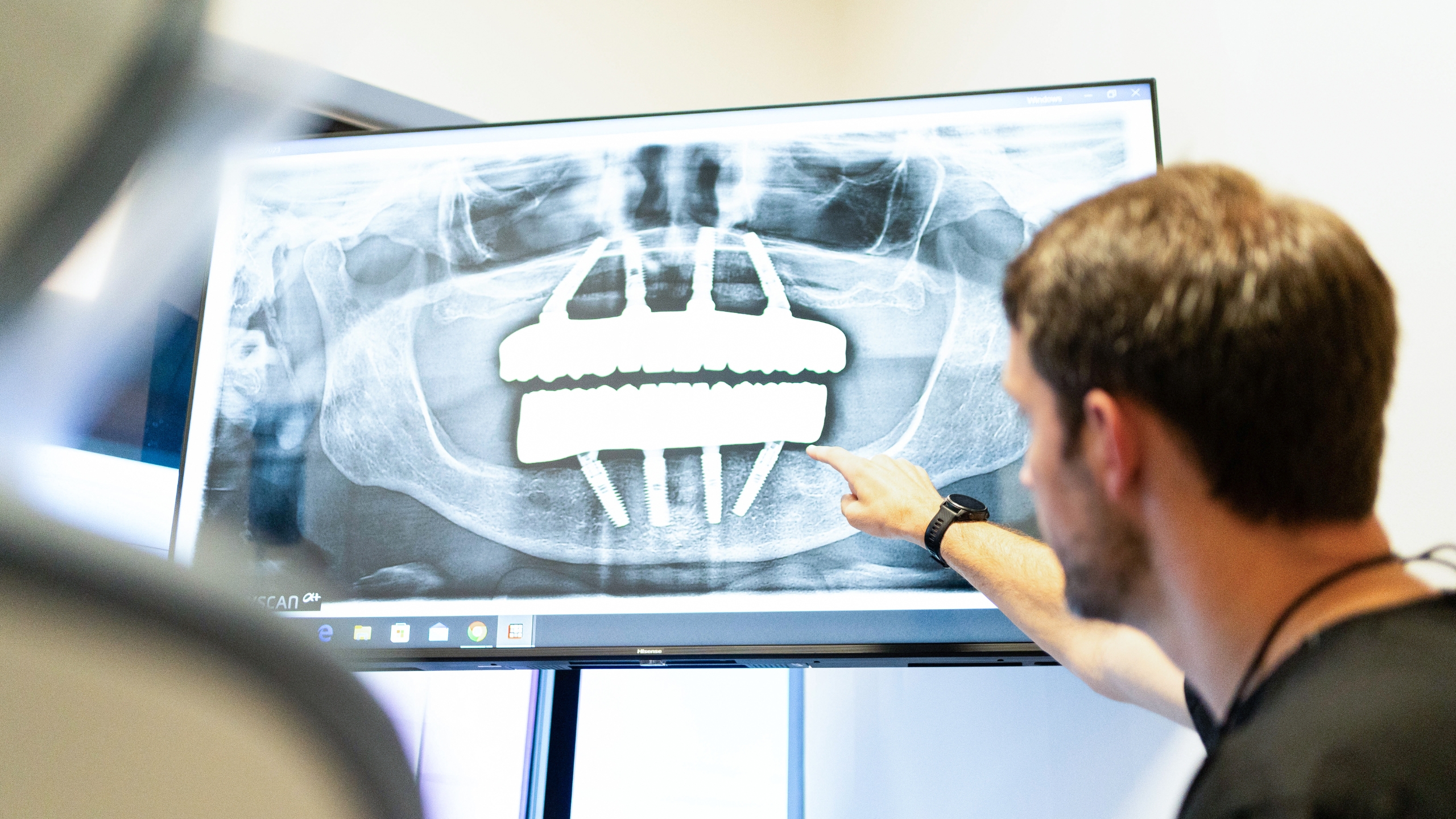 You are currently viewing Top 5 Most Frequently Asked Questions about Dental Implants