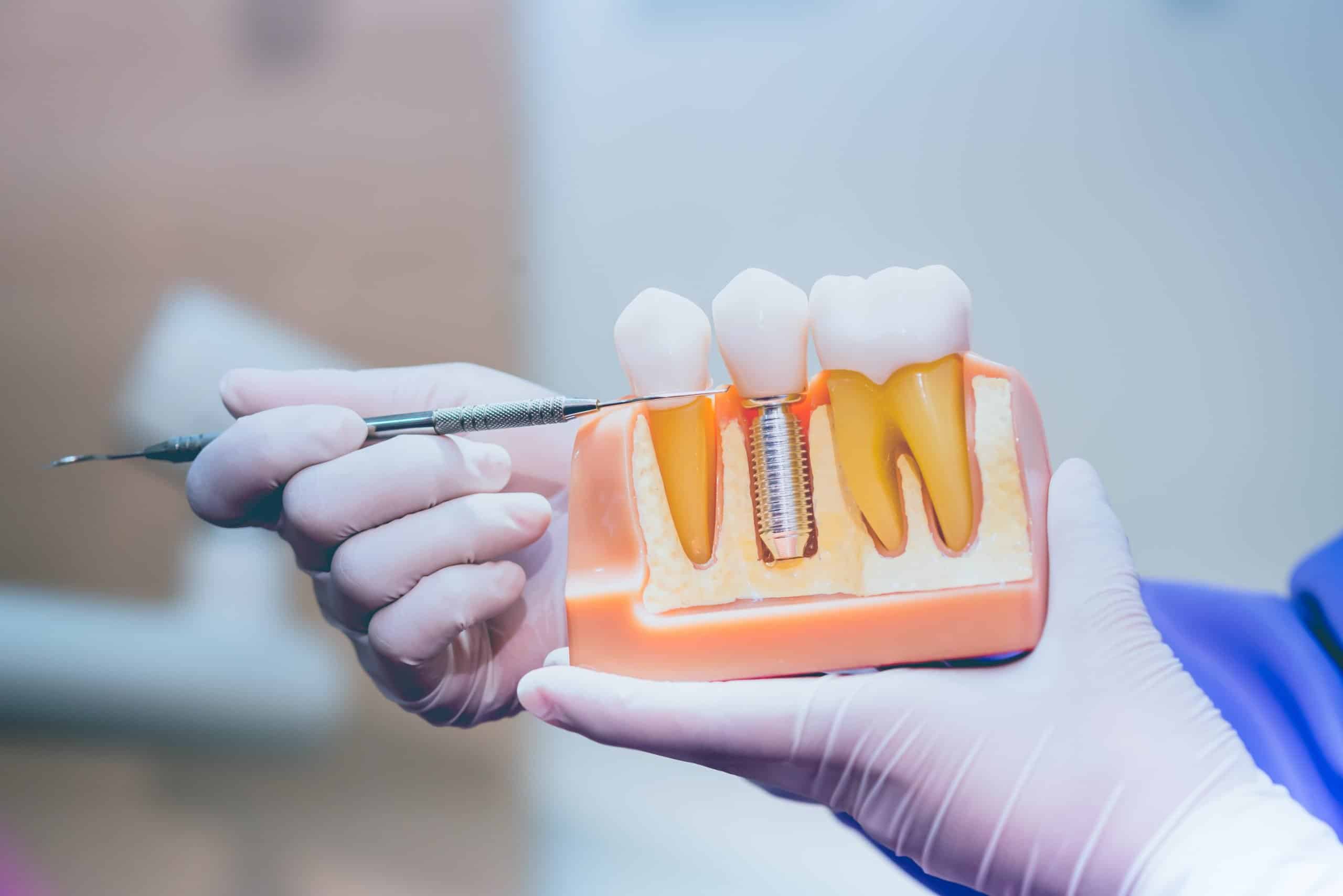 Read more about the article <strong>Dental Implants vs. Bridges</strong>
