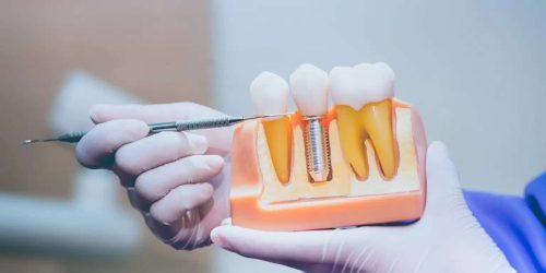 Dental Implants vs. Bridges