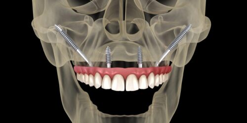 Zygomatic Implants