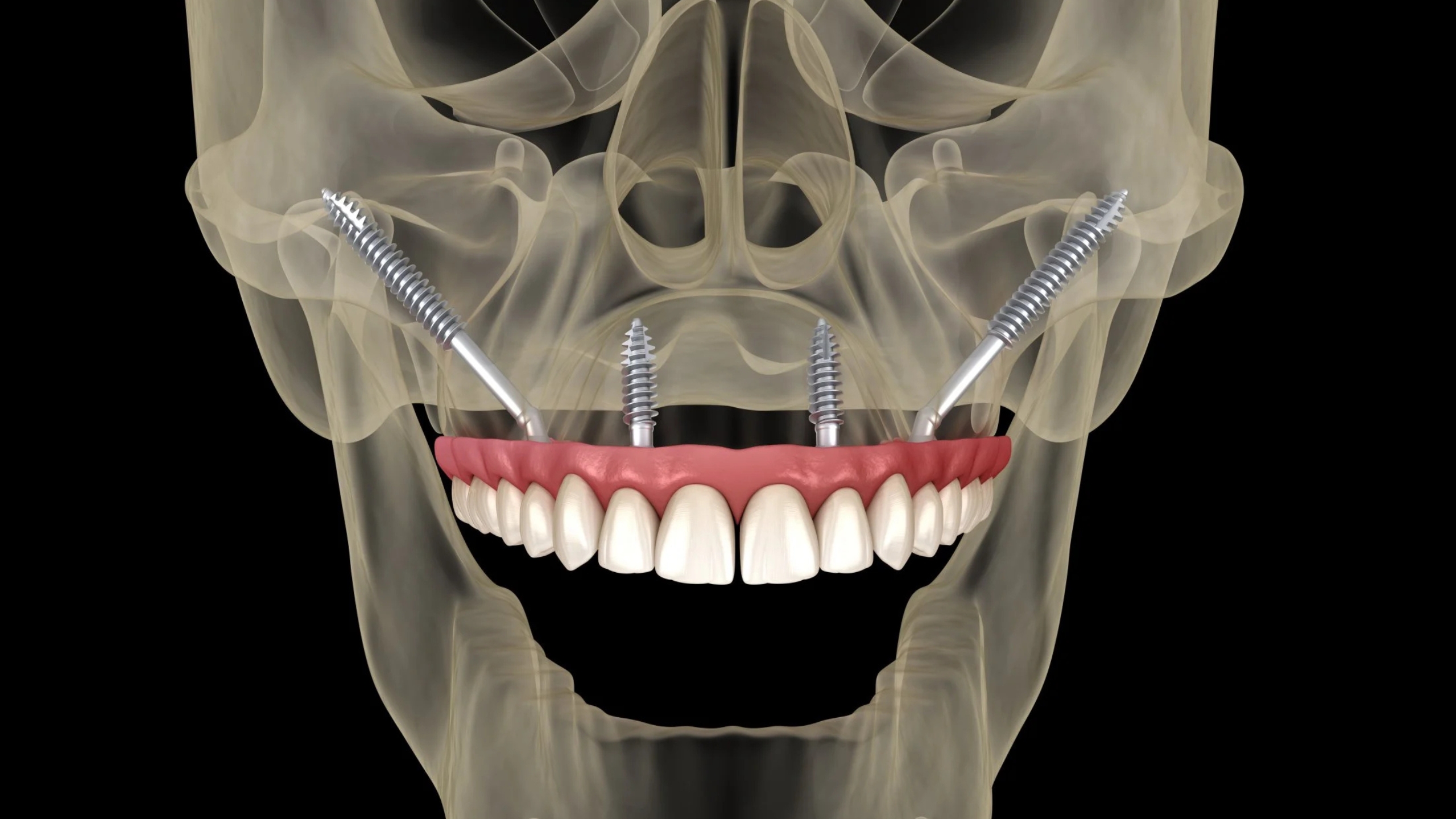 You are currently viewing Zygomatic Implants