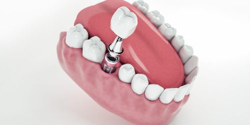 How to Care for Your Dental Implants and Dentures (for Long-Lasting Results)