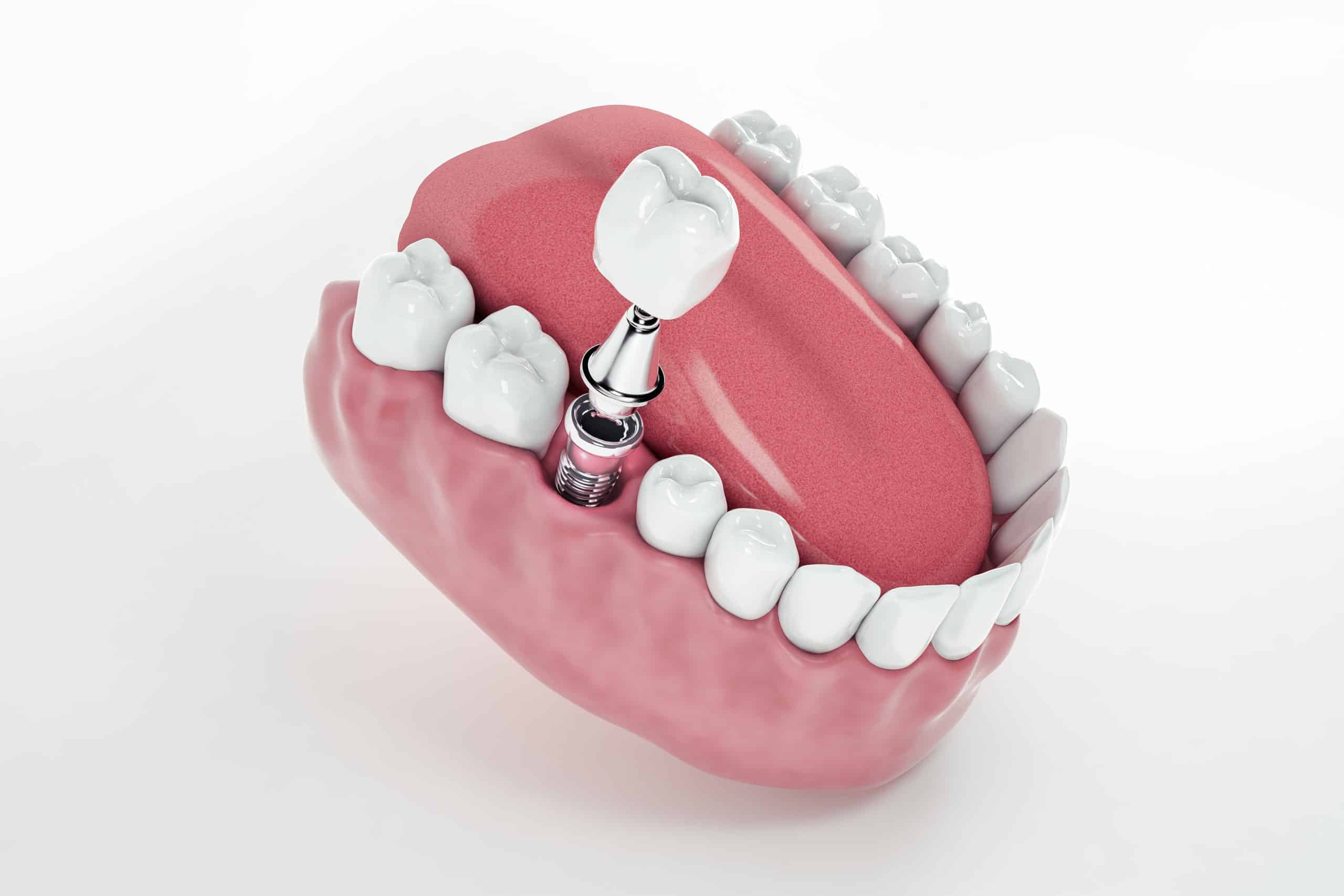 You are currently viewing <strong>How to Care for Your Dental Implants and Dentures (for Long-Lasting Results)</strong>