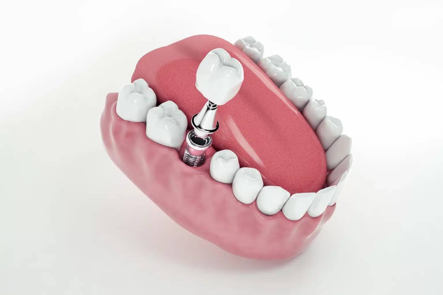 Read more about the article <strong>How to Care for Your Dental Implants and Dentures (for Long-Lasting Results)</strong>