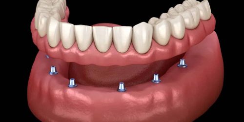 The Advantages Of Implant-Supported Dentures Over Traditional Dentures