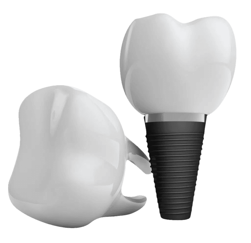 Single tooth Implant or bridges