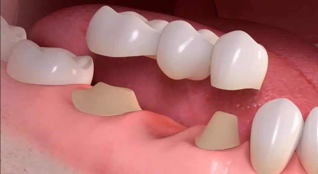 dental bridges and implant near you