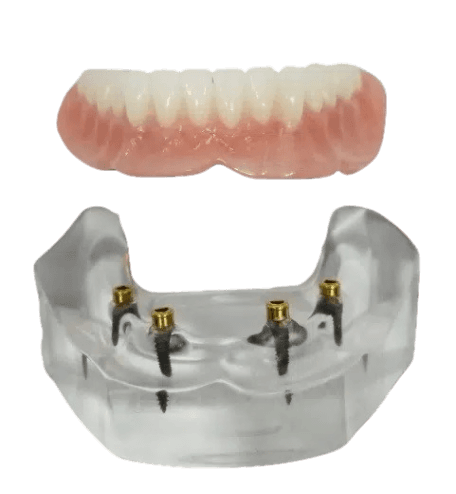 implant dentures snap in dentures near you