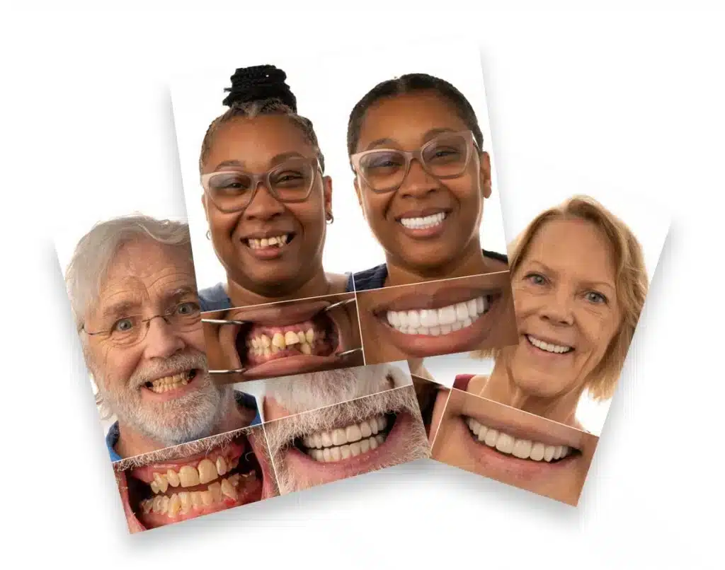 transformation gallery jax implants and dentures