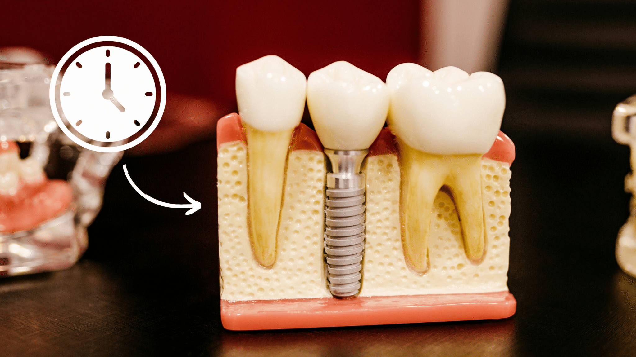 Read more about the article How Long Do Dental Implants Last?