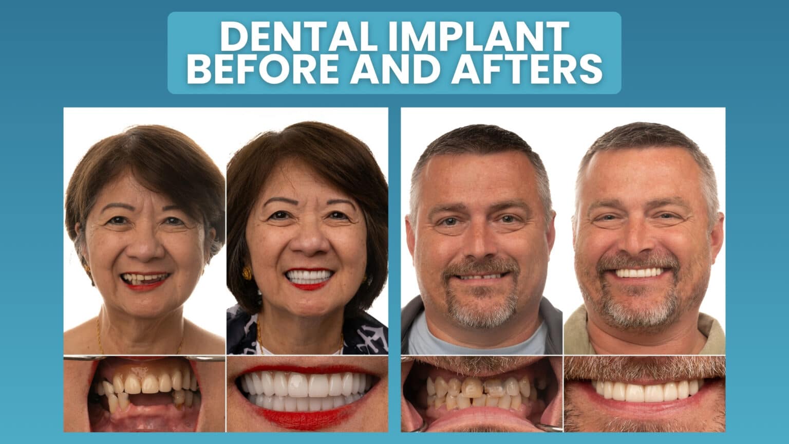 Dental Implants Before and After Transformations - Jax Implants & Dentures