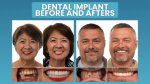 Dental Implants Before and After Transformations